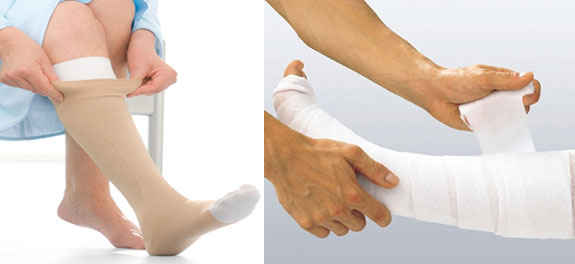 Treating a Venous Leg Ulcer: Compression Hosiery vs Compression Bandages